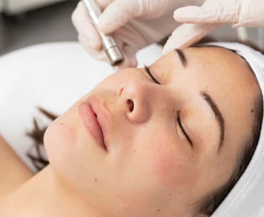 Microneedling versus CO2 laser in acne scars