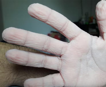 Transgradient Variant of Mal De Meleda