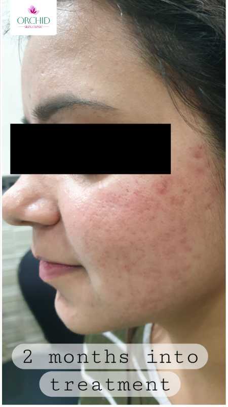 Moderate-Severe Acne Vulgaris Treatment Case Study