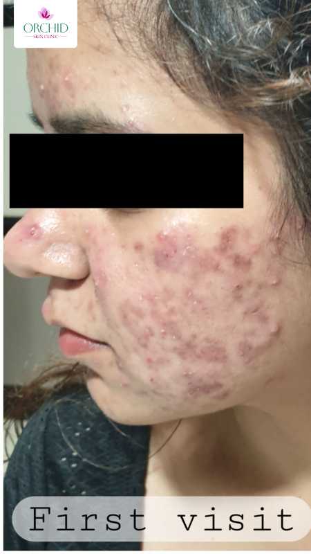First Visit - Moderate-Severe Acne