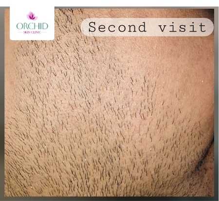 Beard Alopecia Areata Treatment Case Study