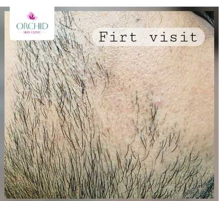 Beard Alopecia Areata - Initial Presentation