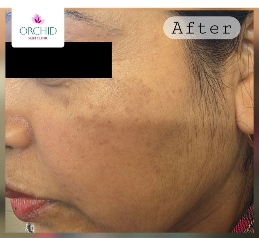 Dermatosis papulosa nigra second case after treatment showing clear skin