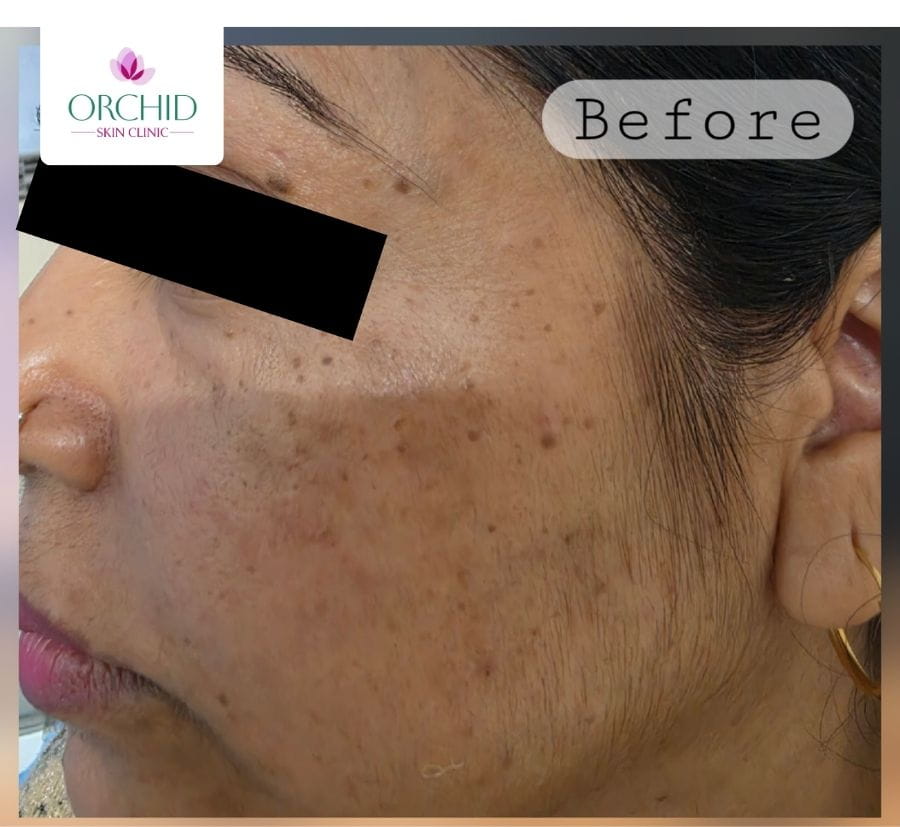 Dermatosis papulosa nigra second case before treatment