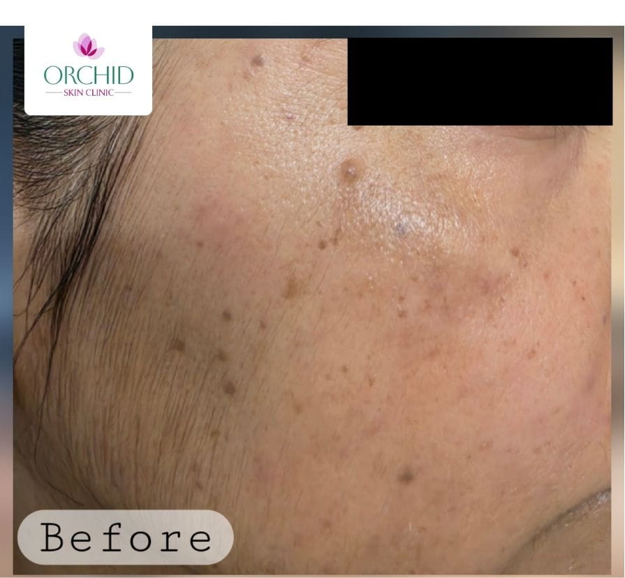 Dermatosis Papulosa Nigra radiofrequency electrocautery case study