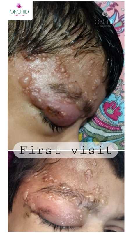Herpes Zoster Ophthalmicus in Pediatric Patient Case Study