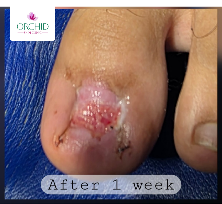 Onychocryptosis Treatment Sample 2