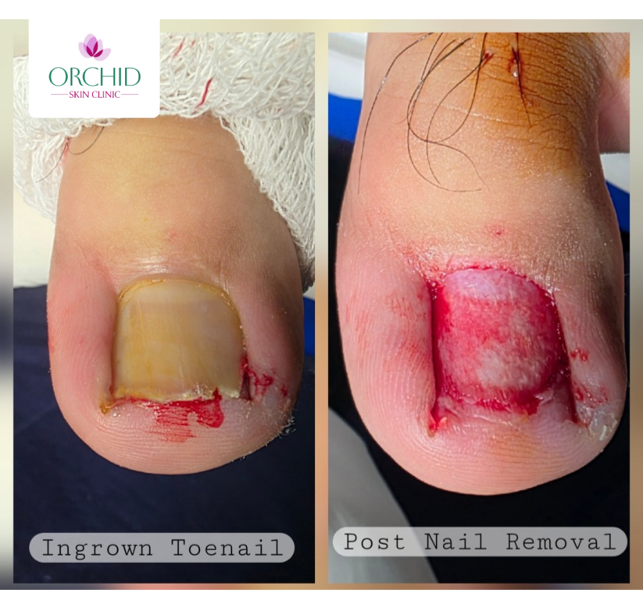 Onychocryptosis Treatment Sample 1