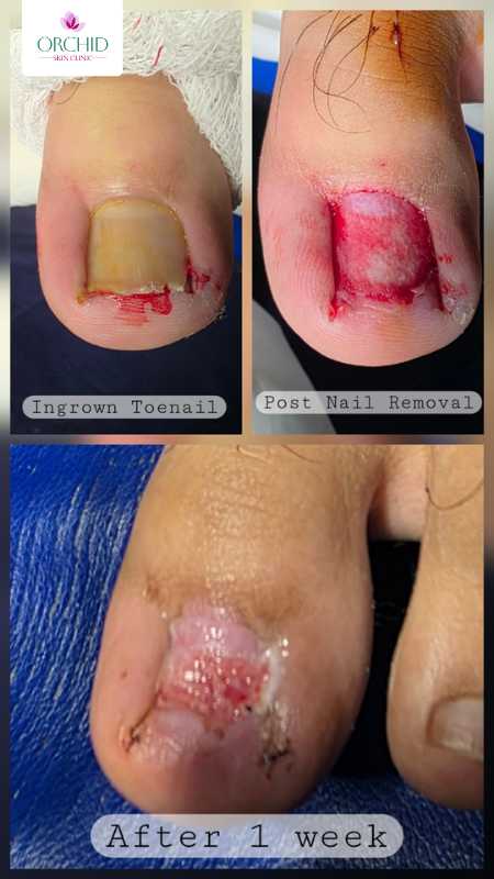 Total Nail Avulsion for Onychocryptosis Case Study