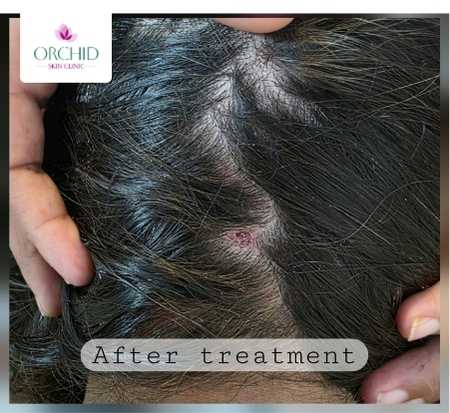 Four Weeks Post-Treatment - Complete Resolution