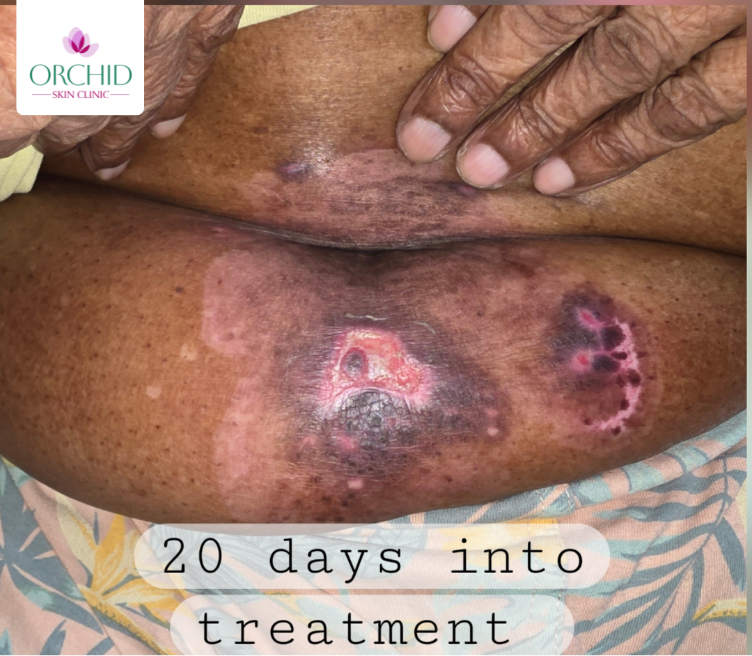 Pemphigus Vulgaris DCP pulse therapy case study