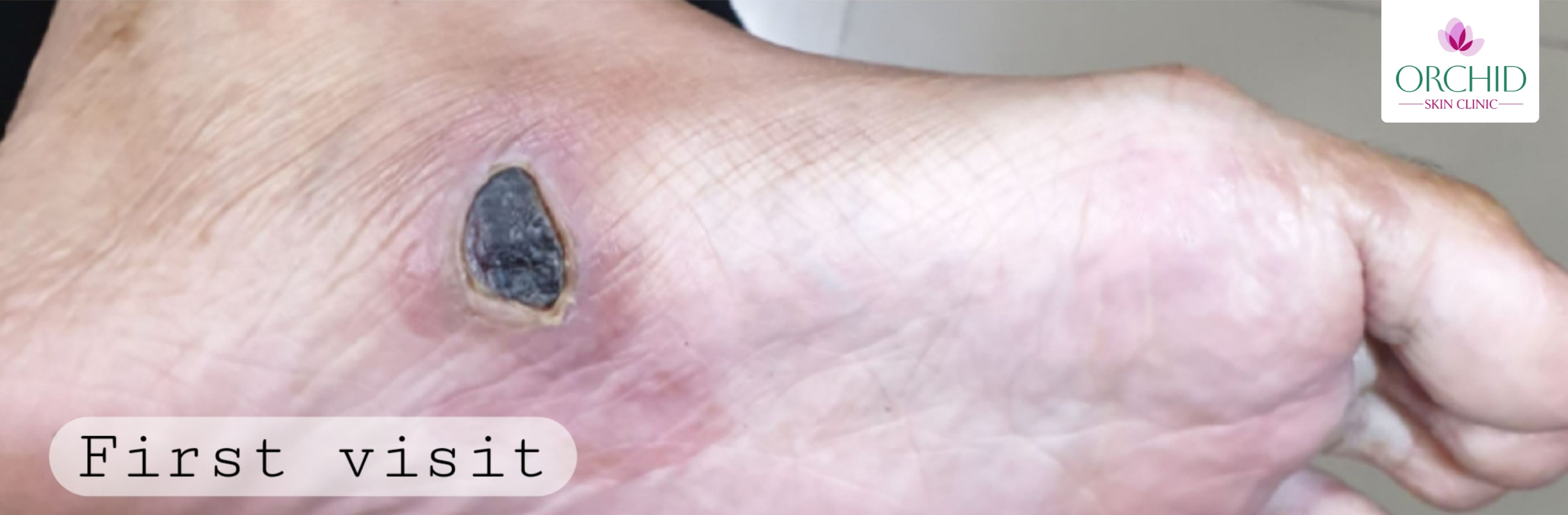 Post-Biopsy Tissue Necrosis on Plantar Foot Case Study